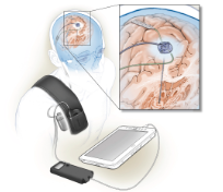 Self-tuning brain implant could help treat patients with Parkinson's disease