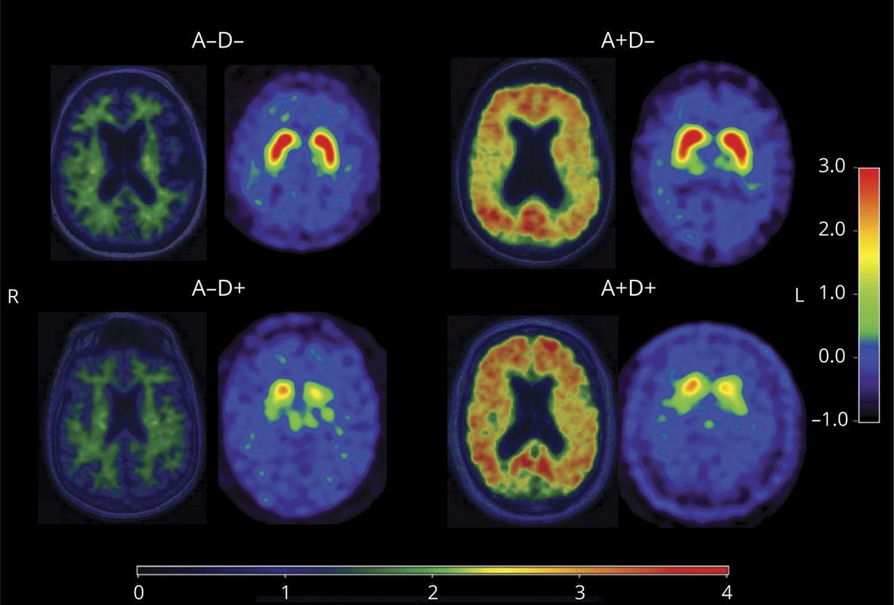 B-Amyloid PET